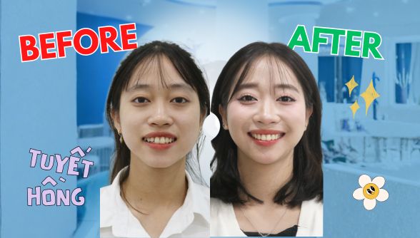 Đổi đời nhan sắc nhờ đầu tư cho nụ cười: Câu chuyện niềng răng của Tuyết Hồng